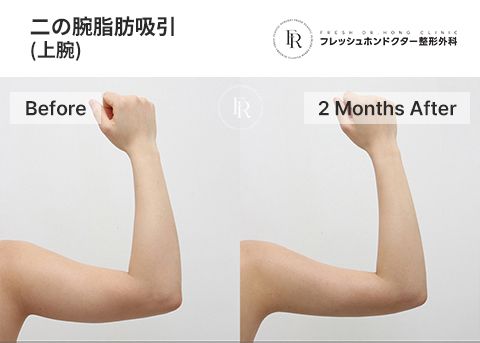 韓国二の腕脂肪吸引｜江南ソウル Fresh Dr. Hong Clinic